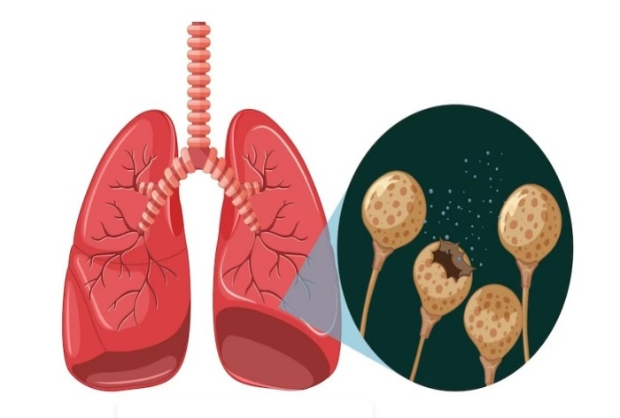 What Is Latent Tuberculosis? Symptoms To Prevention, All You Need To Know