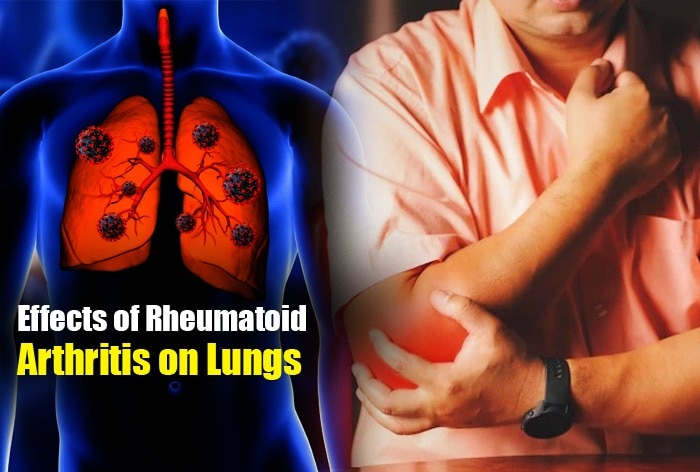 Rheumatoid Arthritis Affects Lungs: Check Symptoms, Treatment And Prevention