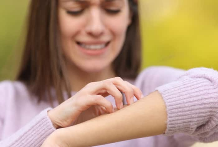 5-home-remedies-to-treat-mosquito-bites-in-summer