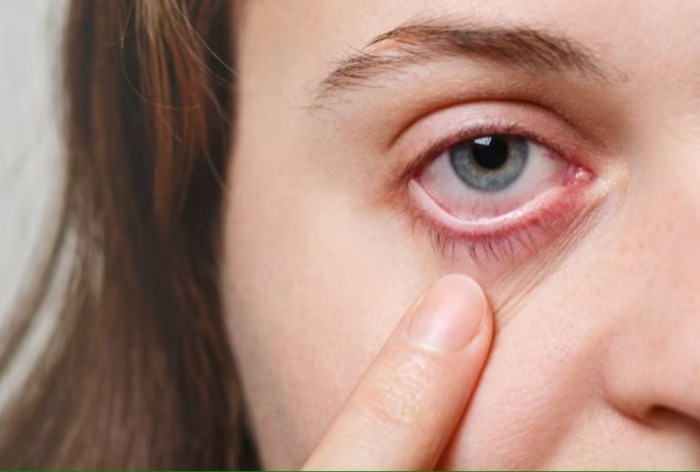 Sunburned Eyes: What is Photokeratitis? Know Signs, Symptoms And Preventive Measure