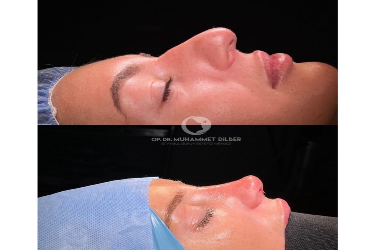 Top 11 Best Rhinoplasty (Nose Job) Doctors in Turkey