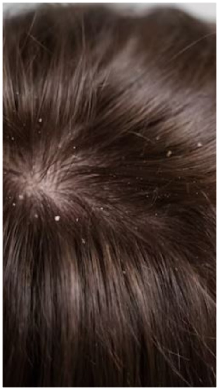 How to Get Rid of Dandruff in Monsoon? 10 Tips
