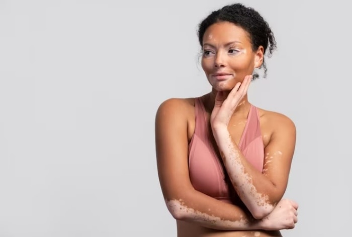 vitiligo myths and facts