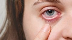 Conjunctivitis: How to Take Care of Your Eyes During Eye Flu? 5 Tips to Follow