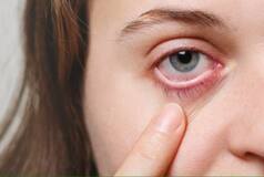 Conjunctivitis: 5 Tips to Quickly Recover From Eye Flu
