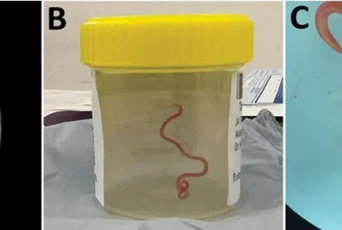 In World’s First, Parasitic Worm Found ‘Alive And Wriggling’ Inside Woman’s Brain In Australia