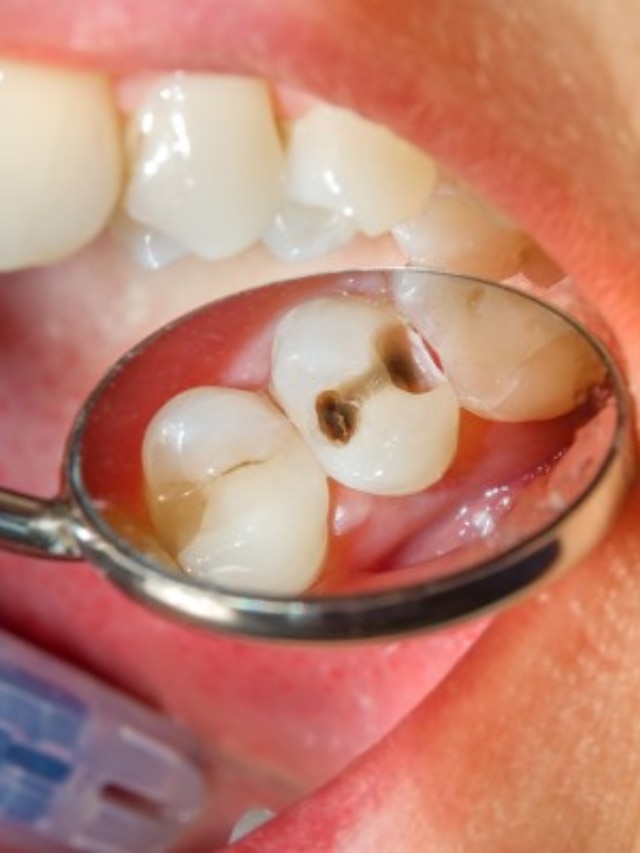 How To Get Rid Of Cavities 7 Home Remedies To Follow