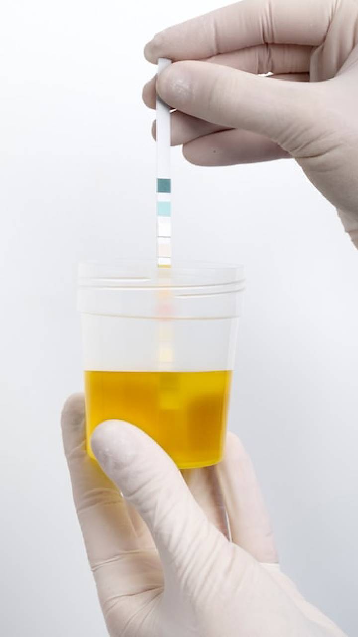 Uric acid 
