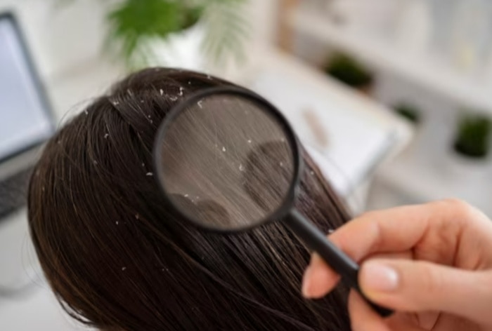 Dandruff in Winter: How to Treat Dry And Flaky Scalp Naturally at Home?