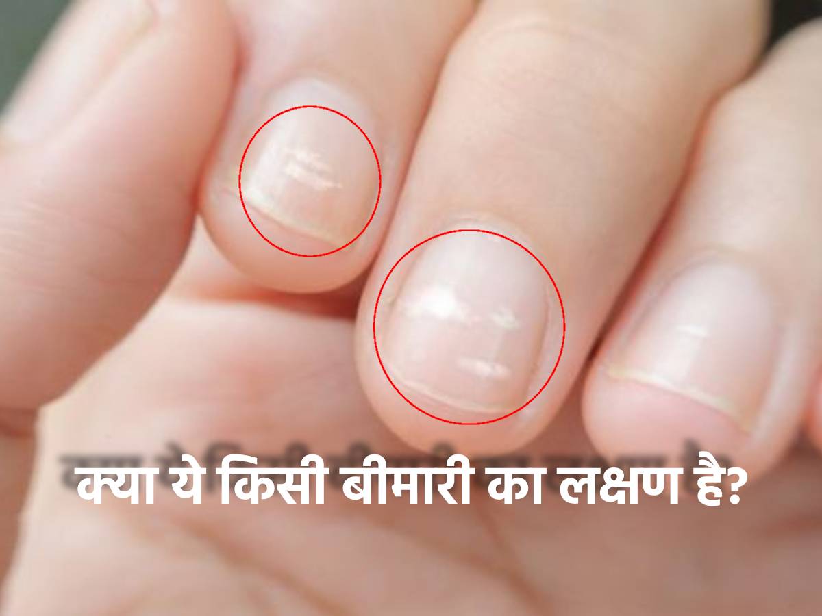 Reading Signs on Nails in Palmistry - Palmistry Nail Signs, नाखूनों पर  धब्‍बे : बताएंगे लाभ या हान‍ि