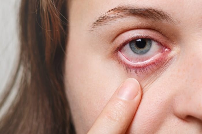 New COVID-19 Symptoms: Is Pink Eye The Warning Sign of This Deadly Variant? Here's All You Need to Know