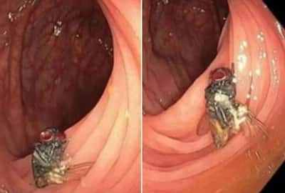 Doctors Find Fully Intact House Fly Inside Mans Intestines, He Went For  Routine Check-Up