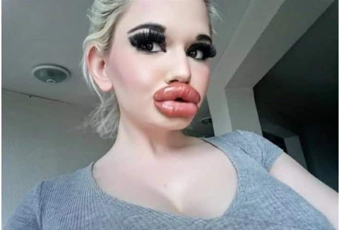 Meet Andrea Ivanova, The Bulgarian Woman Who Spent Rs 20 Lakh to Get The World's Biggest Lips