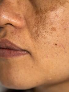 झुर्रियां, झांई और Pimples से छुटकारा पाने के लिए चेहरे पर इस तरह लगाएं कच्चा दूध