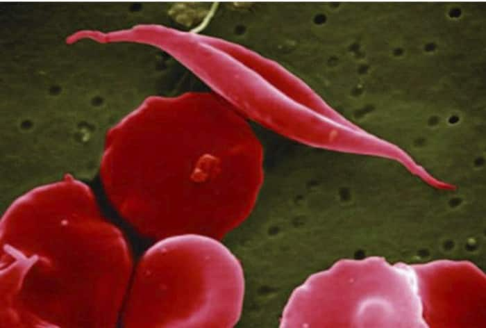 US Approves World's First Crispr Gene-Editing Drug For Sickle-Cell Disease