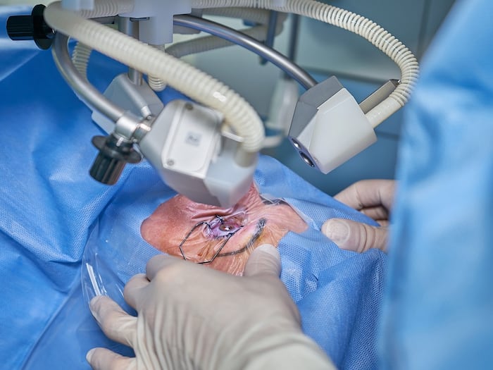 17 Patients Report Vision Loss Following Cataract Surgery, Probe Ordered