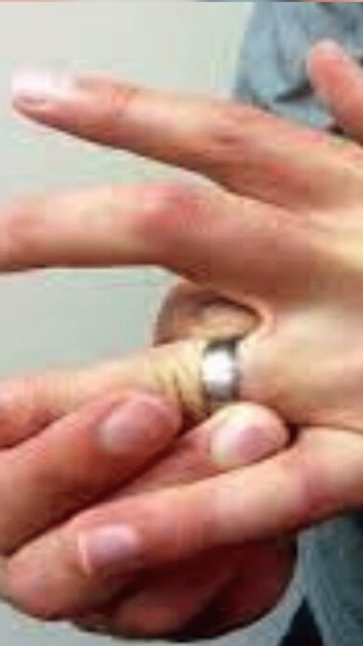 What to do when a ring is stuck on your finger