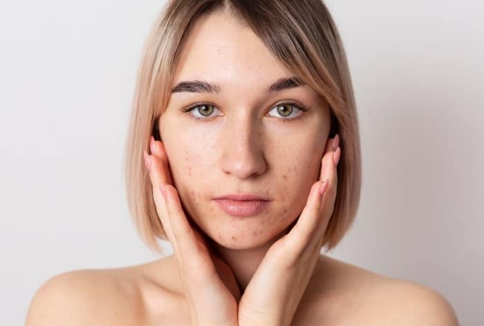 Dryness to Acne Breakout, 6 Ways How Stress Affects Your Skin