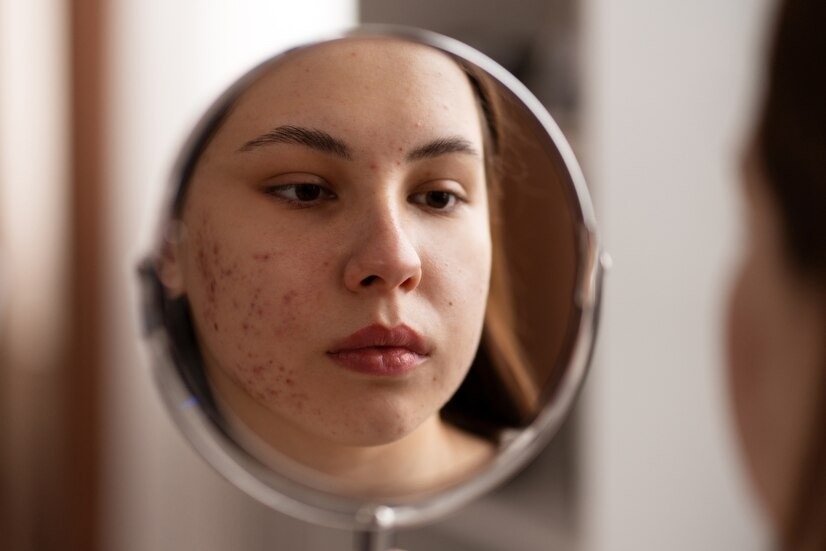 Acne Spots? Here