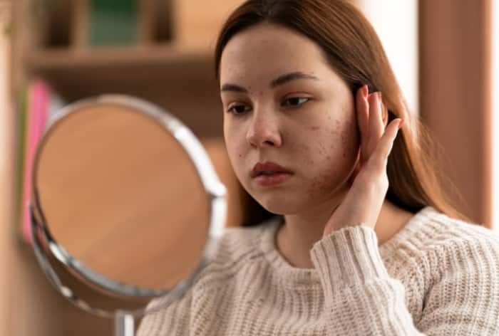 Acne Treatment: 8 Dietary Choices to Make and Get Rid of Pimples