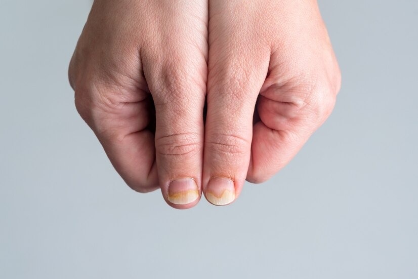 Brittle Nails to Muscle Cramps, 5 Signs That Indicate Low Levels of Calcium in Body