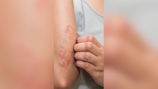 स्किन पर खुजली और सूजन दे सकते हैं Dermatitis का संकेत