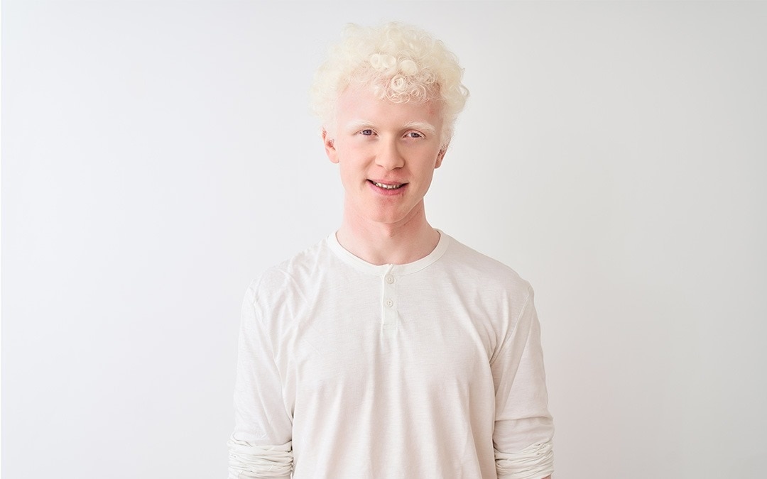 International Albinism Awareness Day 2024: Signs, Causes And Treatment of The Rare Genetic Condition