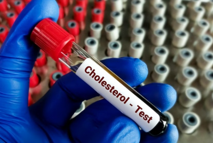 Cholesterol Test: 5 Things to Remember Before Getting Checked For Plaque Build Up