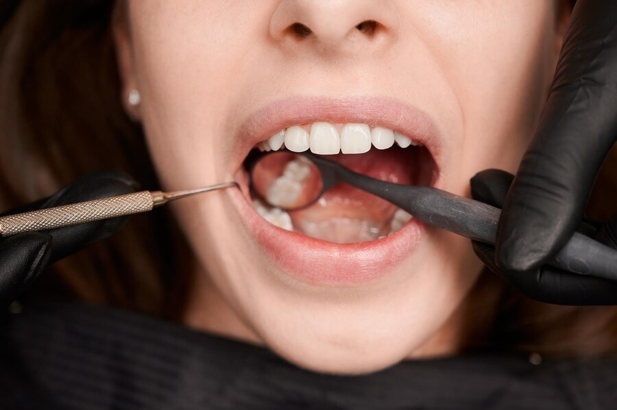 What Happens to Your Tooth Nerves When Cavities Strike? Symptoms And Prevention