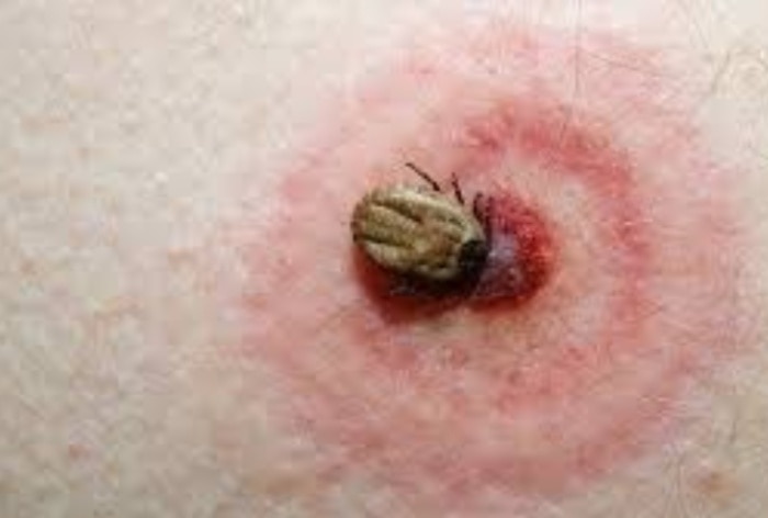 Know causes, symptoms and treatment of this new-tick borne infection