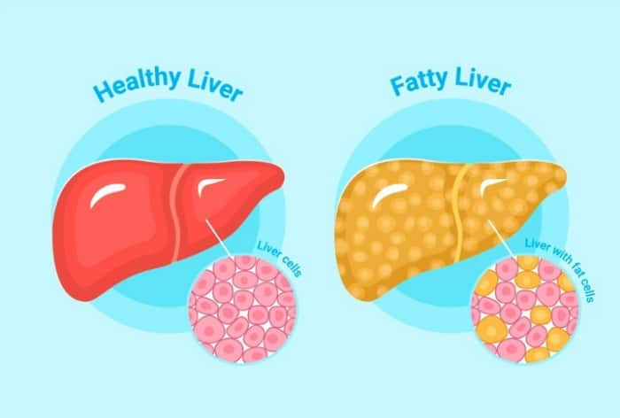 Ways to reduce fatty liver (Freepik)