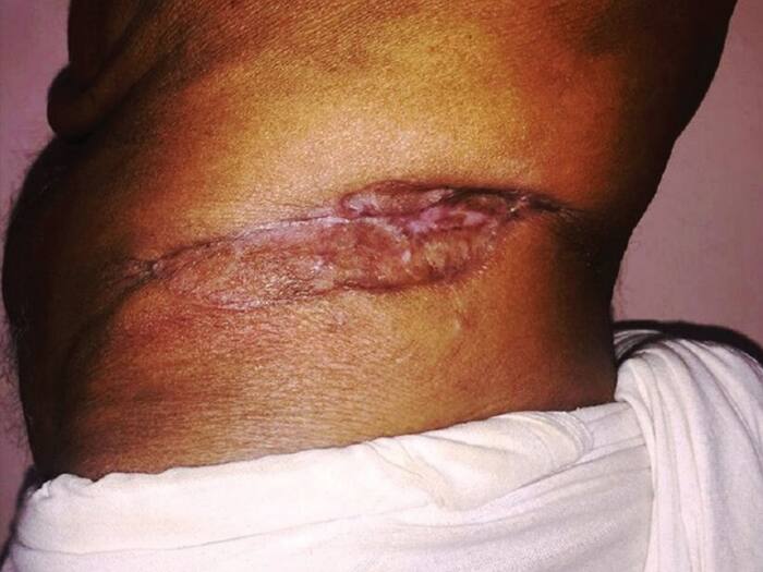 How does Petticoat Cancer occur