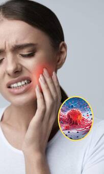 जबड़े में होने वाले कैंसर के ये 5 होते हैं शुरुआती लक्षण