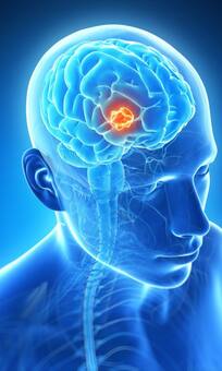 ब्रेन ट्यूमर होने से पहले शरीर देता है ये 5 संकेत! ना करें इग्नोर