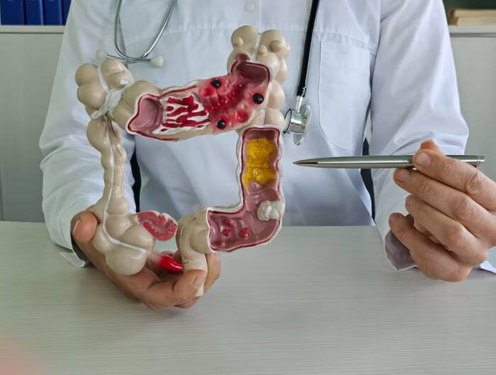 Large intestine cancer facts