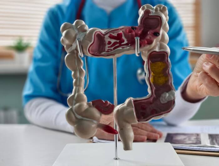 Reatment for colon cancer