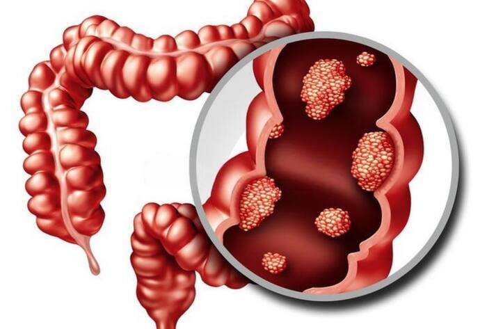 Vibhu raghave colon cancer death intial symptoms in hindi