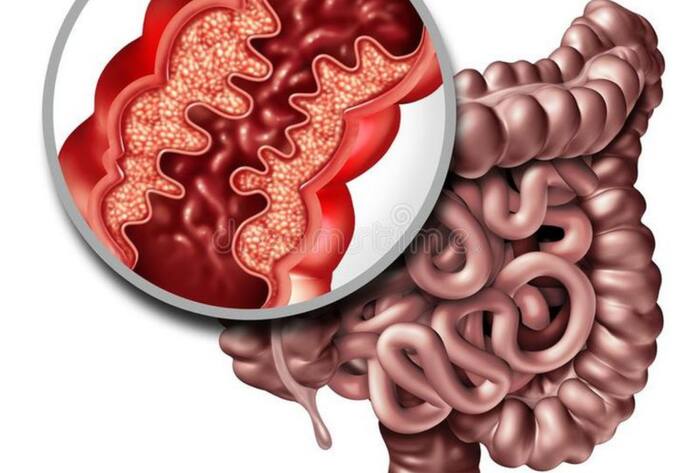 Vibhu raghave colon cancer death intial symptoms in hindi
