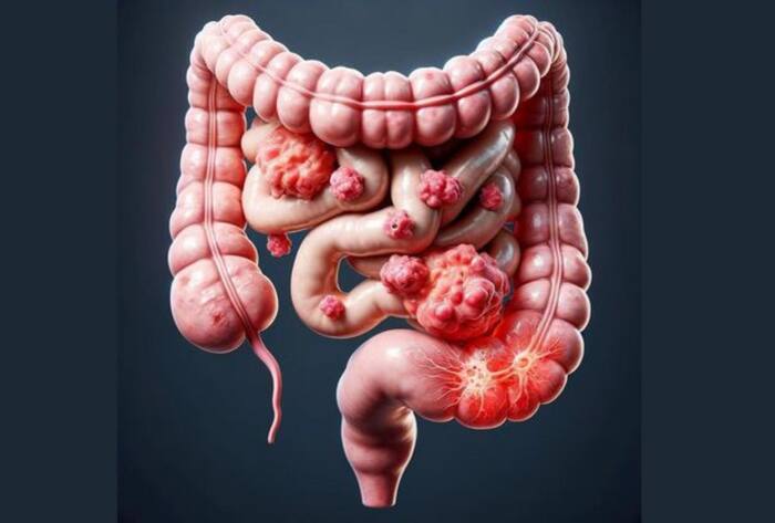 Vibhu raghave colon cancer death intial symptoms in hindi