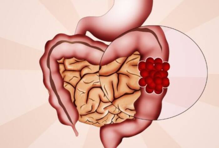 Vibhu raghave colon cancer death intial symptoms in hindi