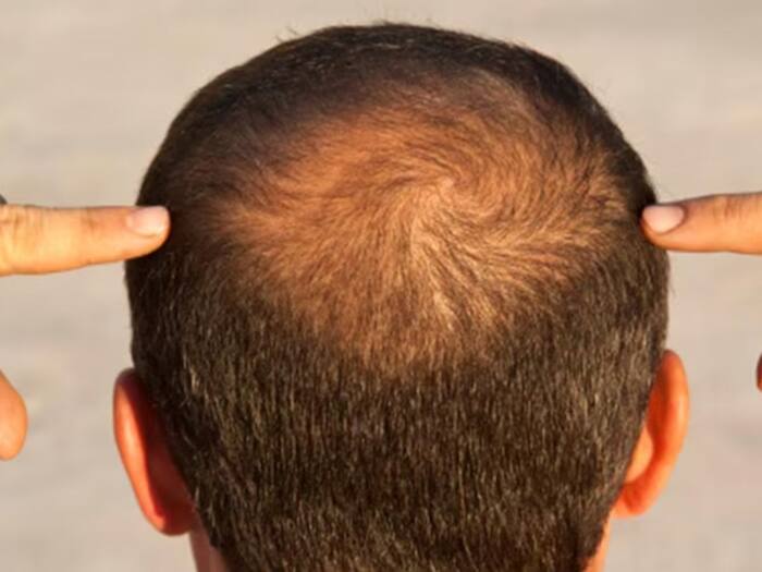 Hair starts falling