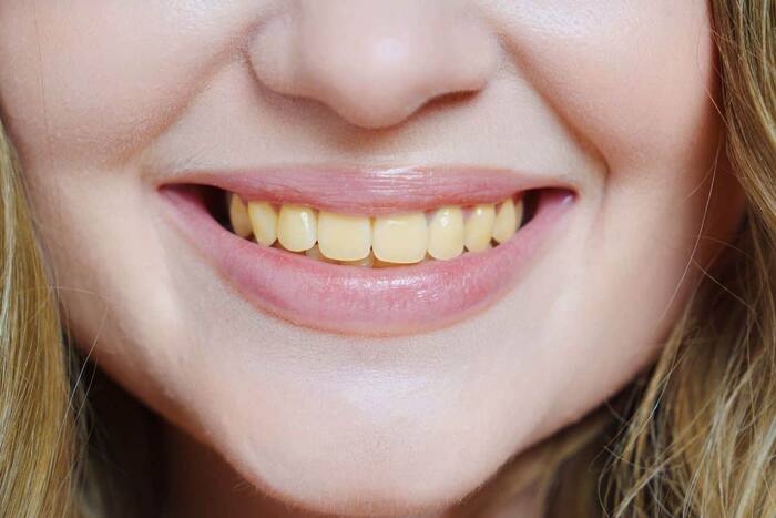 Alum For Teeth Whitening