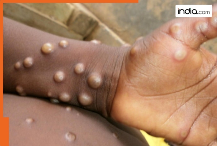 New variant of monkeypox detected in Netherlands; WHO taking it ‘seriously’