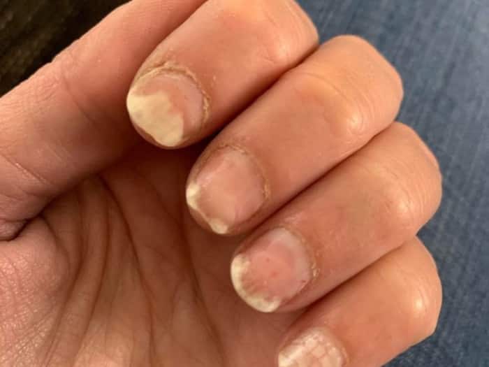 Calcium Deficiency Symptoms