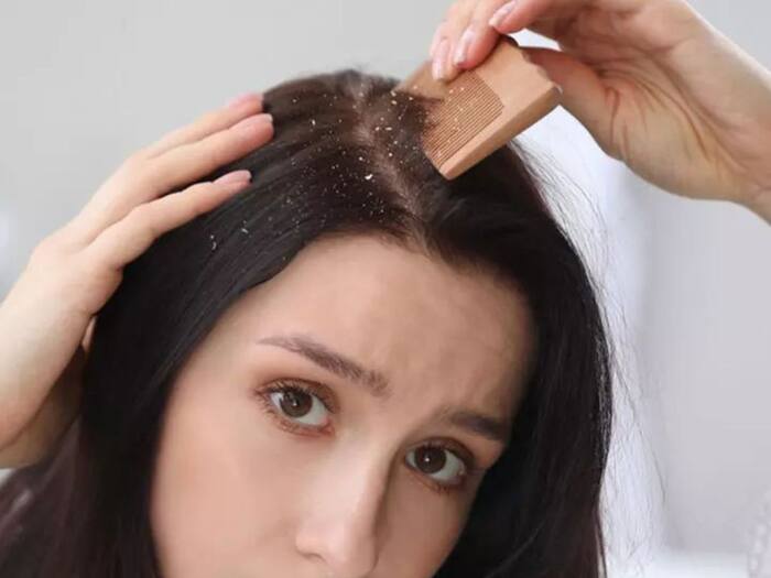 Easy home remedies to reduce dandruff