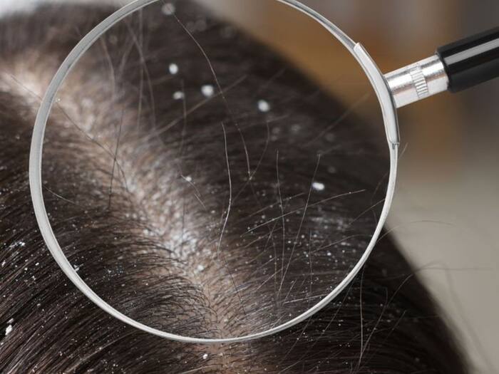 Easy home remedies to reduce dandruff