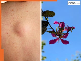 शरीर में बन रही गांठ के लिए वरदान हैं ये जंगली पौधा! इस्तेमाल करते ही टल जाएगा हर तरह का खतरा