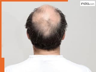 किस विटामिन की कमी से तेजी से झड़ने लगते हैं बाल? गंजा हो जाता है आदमी