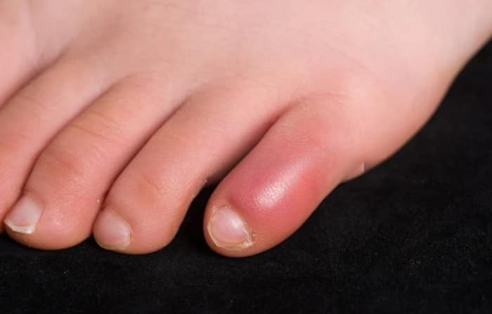 Why do fingers and toes swell in winter