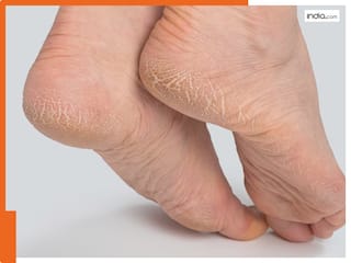 फटी एड़ियां हो जाएंगी मुलायम: ये 5 घरेलू नुस्खे देंगें इंस्टेंट रिलीफ